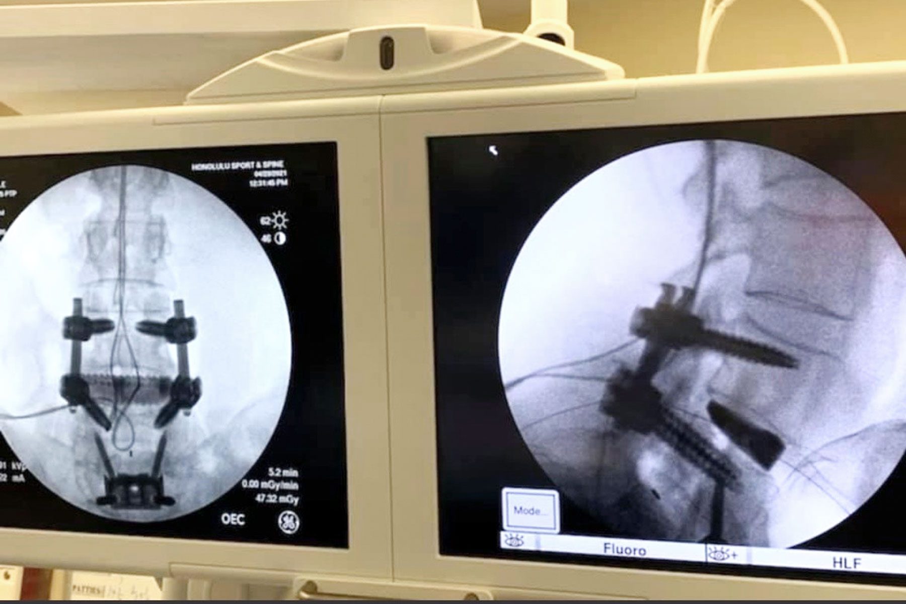 An x-ray of Danielle Moore's gymnastics injury.