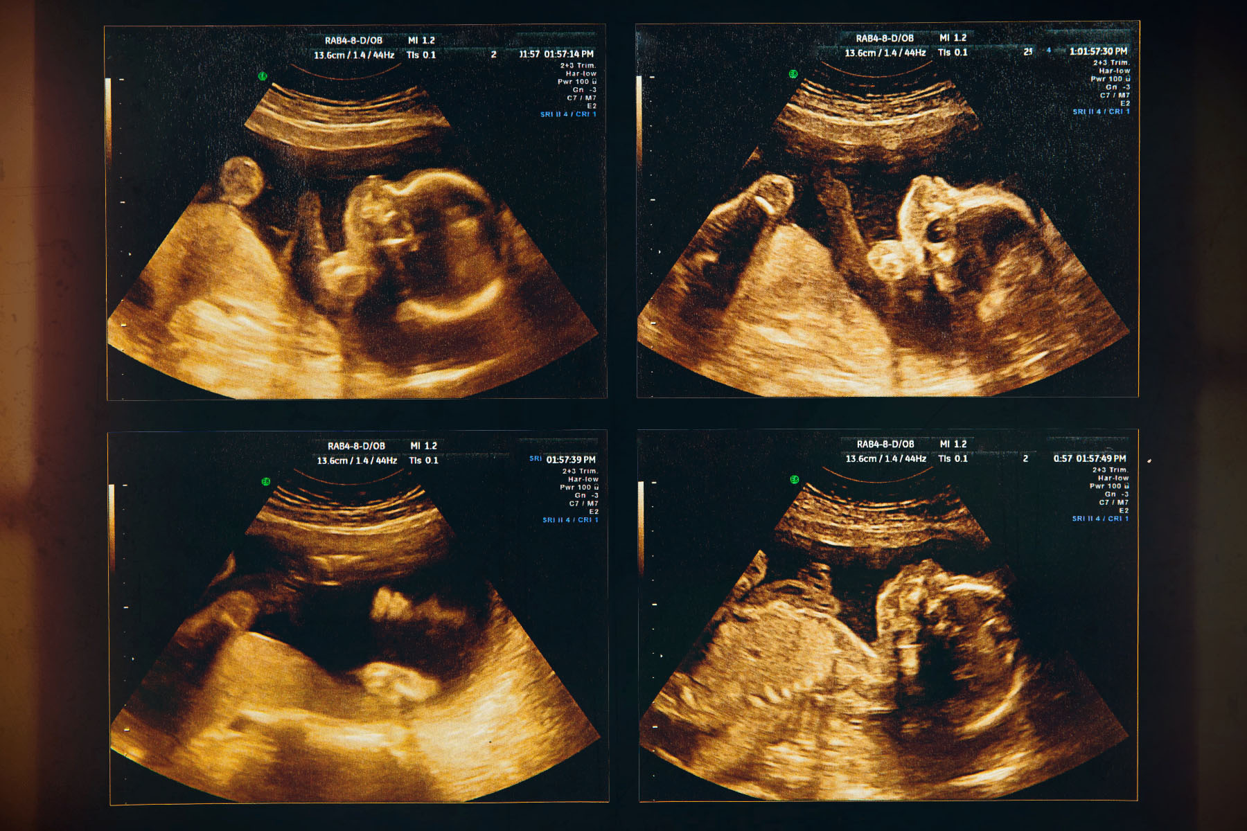 Four ultrasounds of a 24 week old fetus